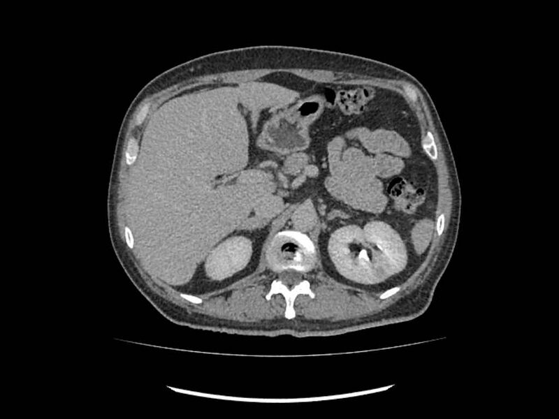 File:Brain metastases from renal cell carcinoma (Radiopaedia 42222-45328 Axial C+ delayed 43).jpg