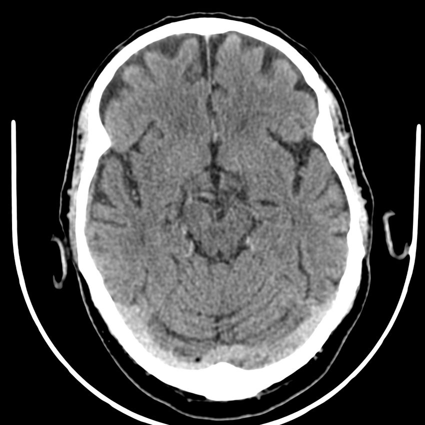 Brain metastasis (Radiopaedia 42617-45760 Axial non-contrast 17).jpg