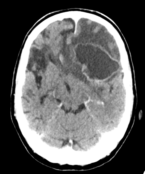 File:Brain metastasis (lung cancer) (Radiopaedia 48289-53177 Axial C+ 12).png