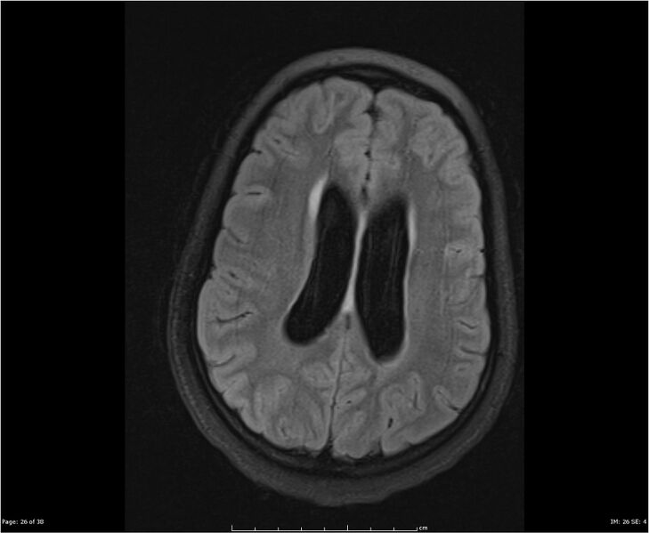 File:Brainstem glioma (Radiopaedia 21819-21775 Axial FLAIR 26).jpg