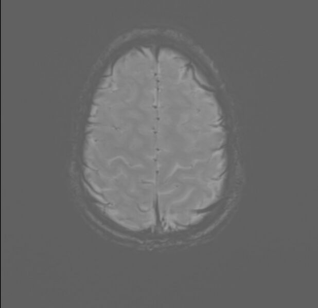 File:Brainstem glioma (Radiopaedia 70548-80674 Axial SWI 55).jpg