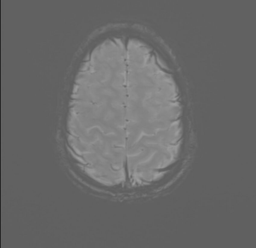 Brainstem glioma (Radiopaedia 70548-80674 Axial SWI 55).jpg