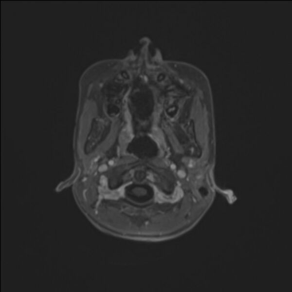 File:Brainstem glioma (Radiopaedia 70548-80674 Axial T1 C+ 13).jpg