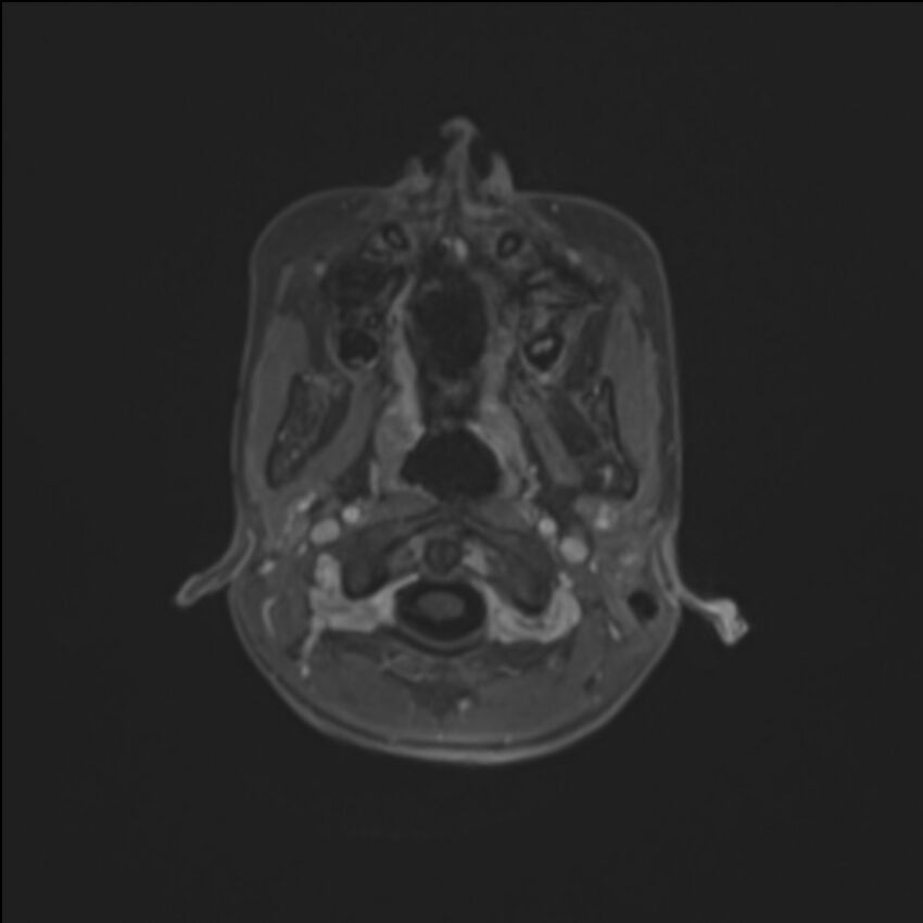 Brainstem glioma (Radiopaedia 70548-80674 Axial T1 C+ 13).jpg