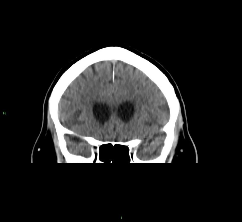 Brainstem hemorrhage (Radiopaedia 58794-66028 Coronal non-contrast 45).jpg