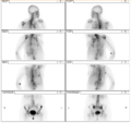 Breast cancer skeletal metastases (Radiopaedia 80148-93456 B 1).PNG