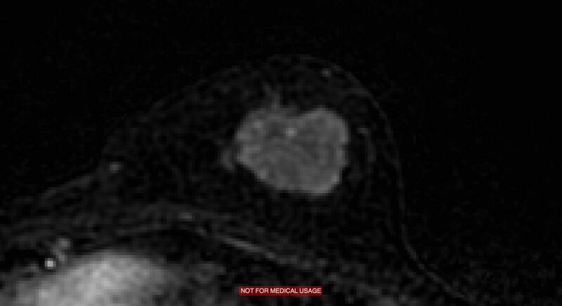File:Breast lymphoma (MRI) (Radiopaedia 34999-36498 C 14).jpg