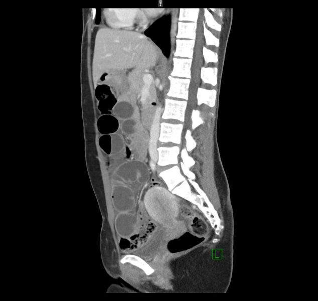 File:Broad ligament hernia (Radiopaedia 63260-71832 C 26).jpg