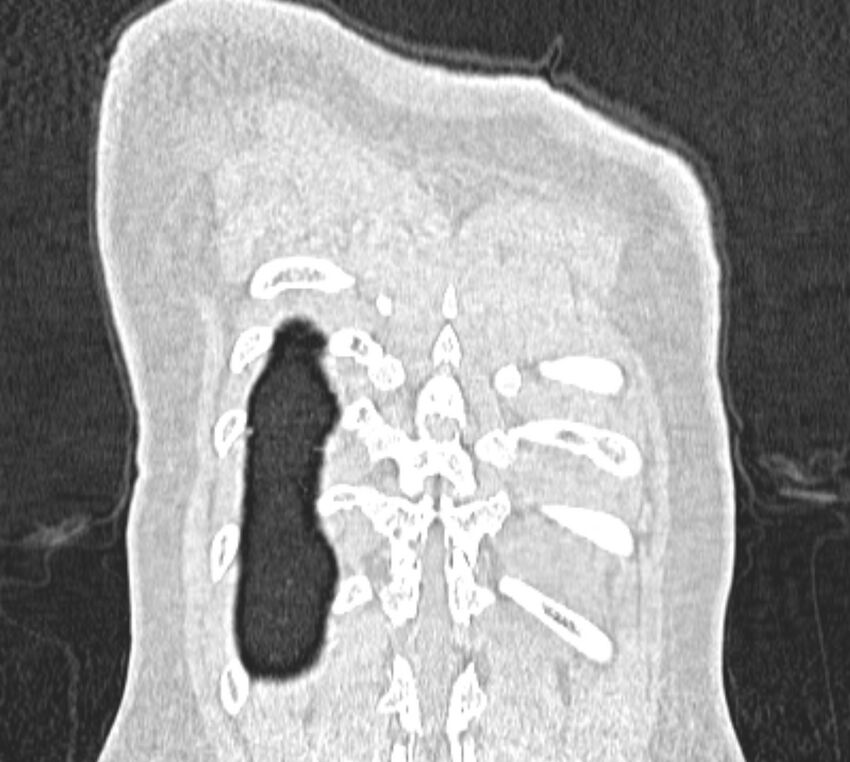 Bronchial atresia (Radiopaedia 50007-55297 Coronal lung window 113).jpg