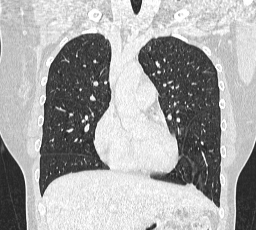 Bronchial atresia (Radiopaedia 50007-55297 Coronal lung window 35).jpg