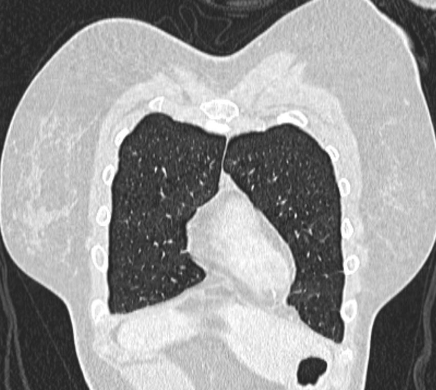 Bronchial atresia (Radiopaedia 50007-55297 Coronal lung window 9).jpg
