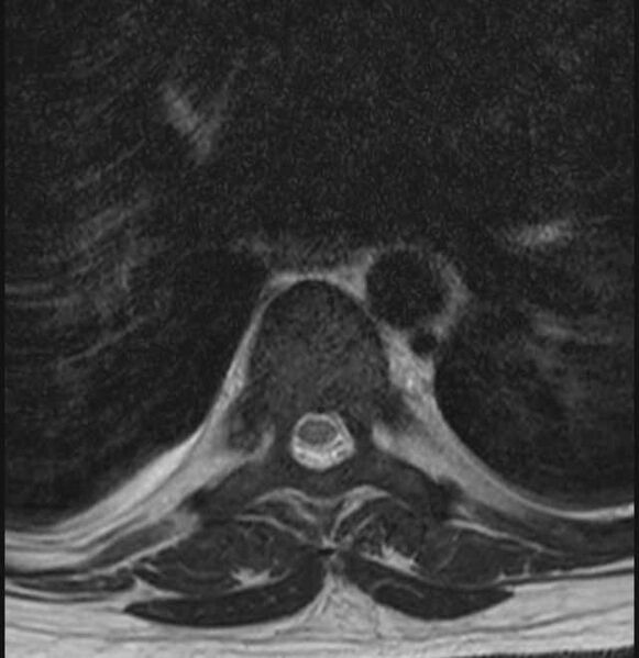 File:Brown tumors compressing the spinal cord (Radiopaedia 68442-78030 A 27).jpg