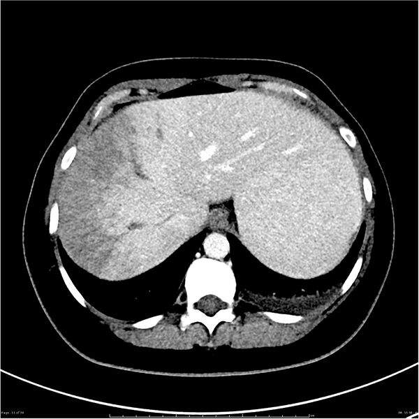 File:Budd-Chiari syndrome (Radiopaedia 27929-28177 Axial liver window 11).JPG