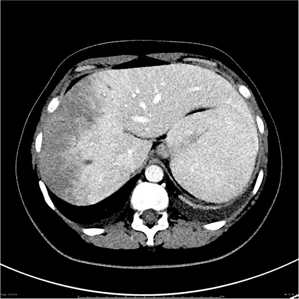 File:Budd-Chiari syndrome (Radiopaedia 27929-28177 Axial liver window 13).JPG