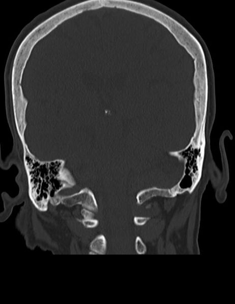 File:Burnt-out meningioma (Radiopaedia 51557-57337 Coronal bone window 34).jpg