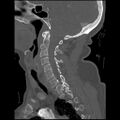 C1 anterior arch (plough) fracture - type 1 (Radiopaedia 76181-87720 Sagittal bone window 63).jpg