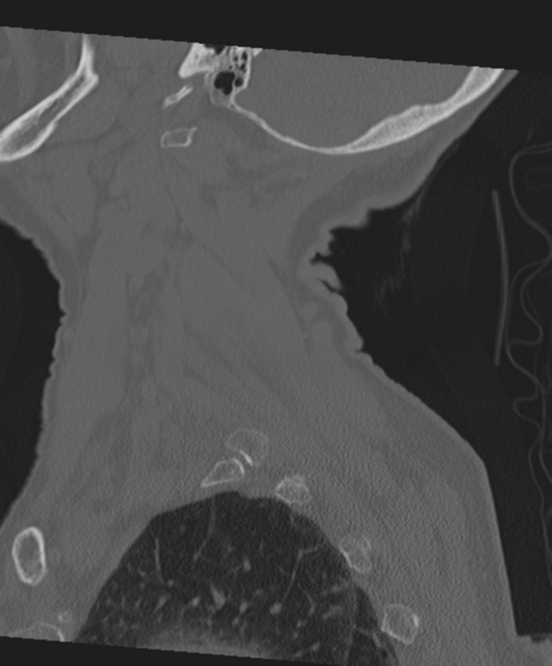 File:C2 fracture with vertebral artery dissection (Radiopaedia 37378-39199 Sagittal bone window 16).png