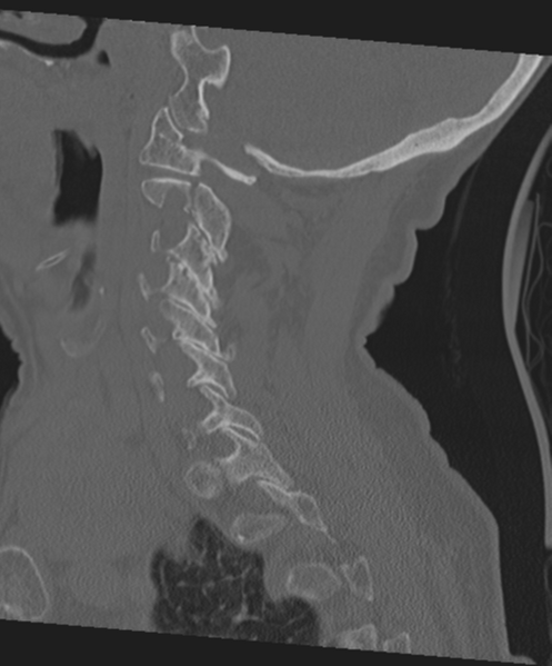 File:C2 fracture with vertebral artery dissection (Radiopaedia 37378-39199 Sagittal bone window 51).png