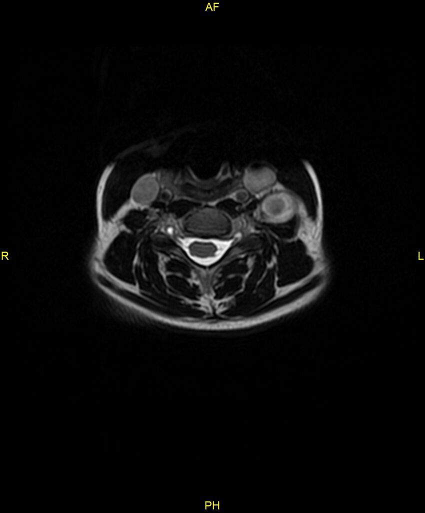 C5 nerve sheath tumor (Radiopaedia 85777-101596 Axial T2 35).jpg