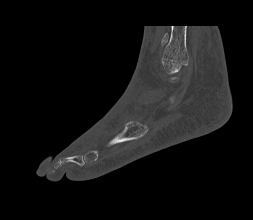 Calcaneal tuberosity avulsion fracture (Radiopaedia 22649-22668 Sagittal bone window 9).jpg