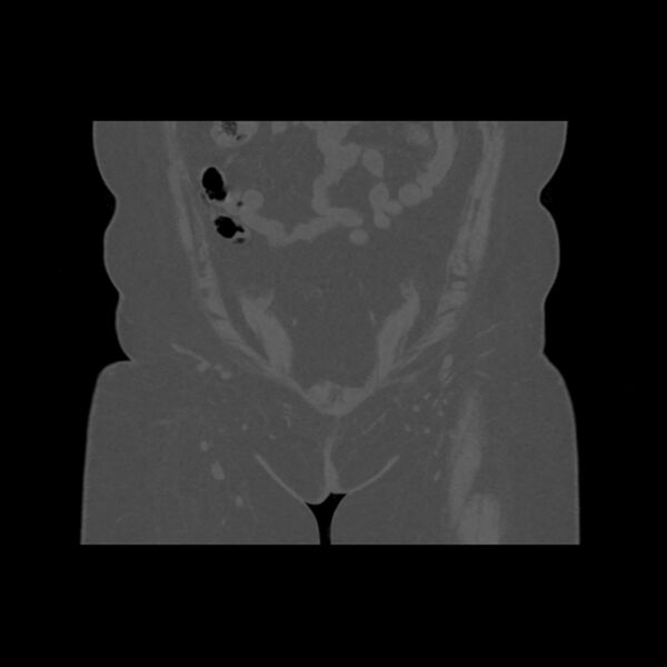 File:Calcific tendinitis of the gluteus medius muscle (Radiopaedia 66998-76318 Coronal bone window 6).jpg