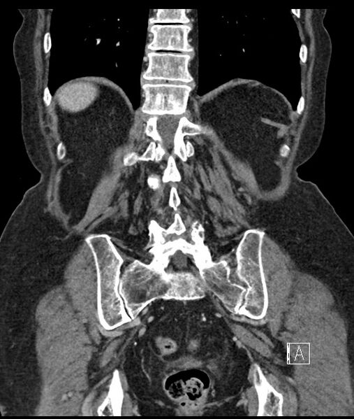 File:Calcified adrenal glands and Spigelian hernia (Radiopaedia 49741-54988 B 90).jpg