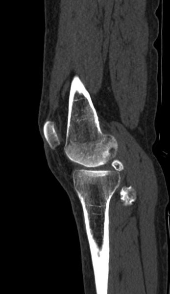 File:Calcified hematoma - popliteal fossa (Radiopaedia 63938-72763 Sagittal bone window 6).jpg