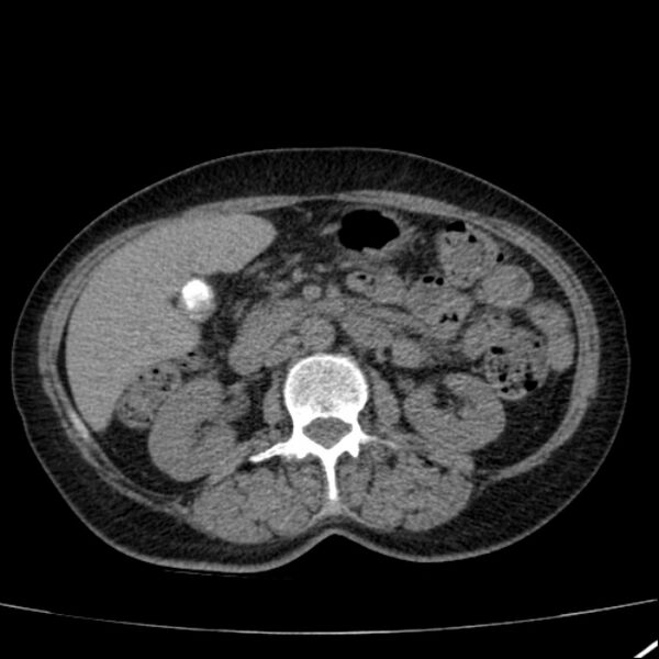 File:Calcified hepatic hydatid cyst (Radiopaedia 26872-27046 Axial non-contrast 38).jpg