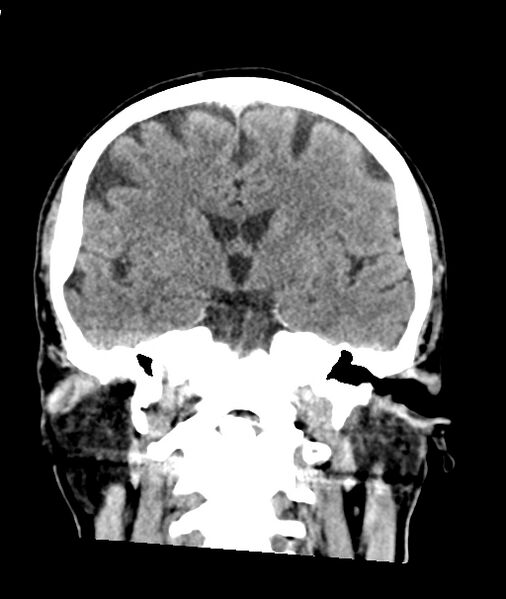 File:Calcified meningioma (Radiopaedia 74361-85243 Coronal non-contrast 27).jpg