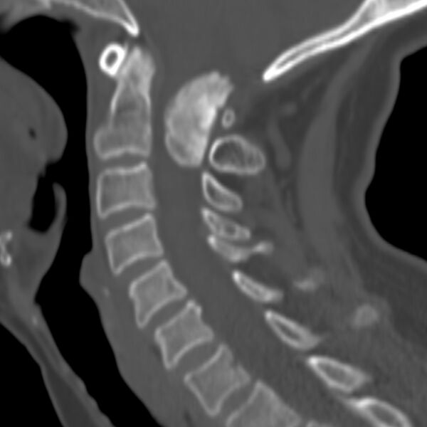 File:Calcified meningioma - cervical canal (Radiopaedia 70136-80171 Sagittal bone window 18).jpg