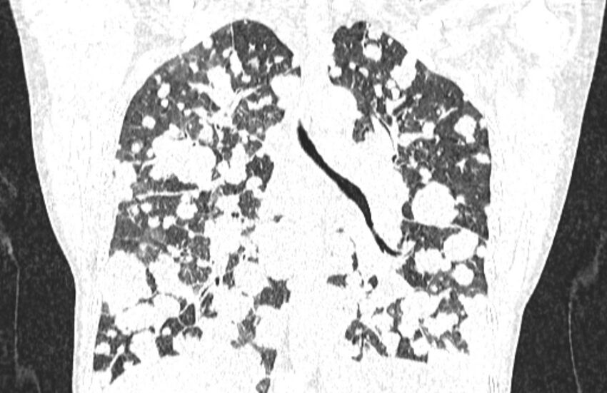 Cannonball metastases from breast cancer (Radiopaedia 91024-108569 Coronal lung window 88).jpg