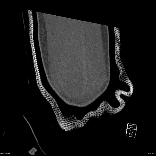File:Capitellum fracture (Radiopaedia 23352-23426 Coronal bone window 7).jpg