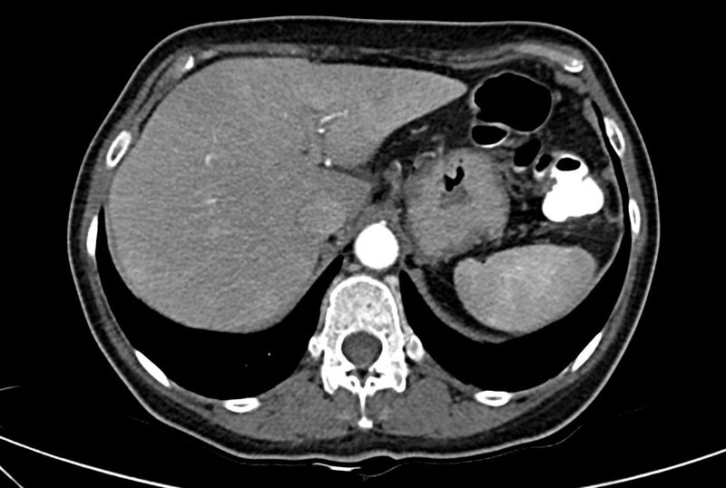 File:Carcinoid mesenteric tumor complicated by chylous ascites (Radiopaedia 76312-88926 A 14).jpg