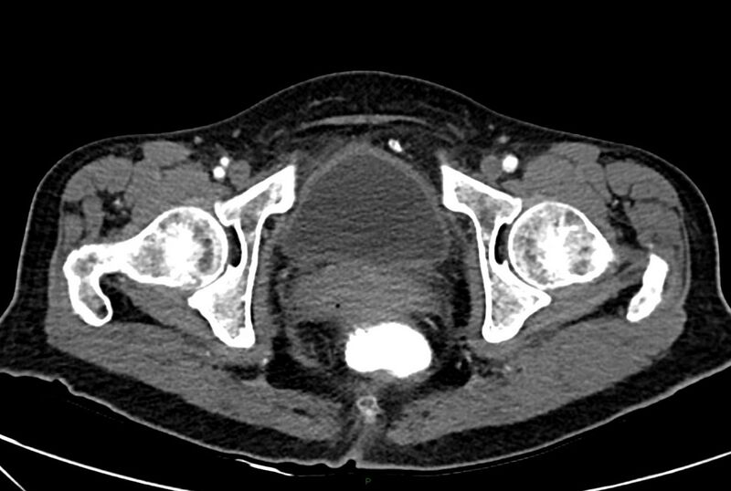 File:Carcinoid mesenteric tumor complicated by chylous ascites (Radiopaedia 76312-88926 A 75).jpg
