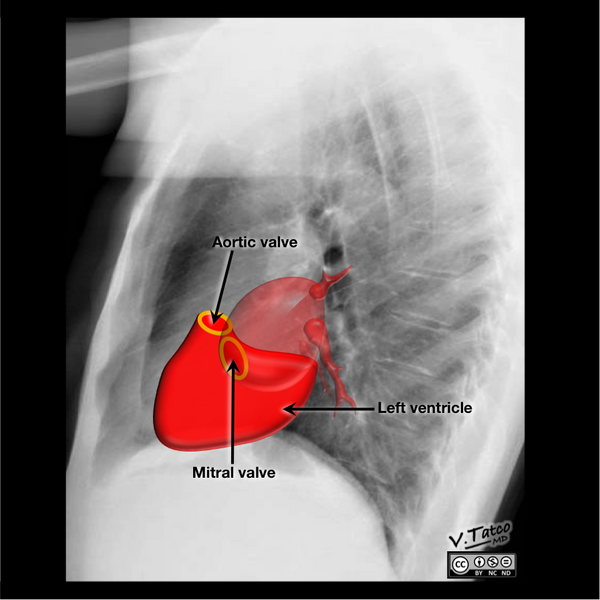 File:Cardiomediastinal anatomy on chest radiography (annotated images) (Radiopaedia 46331-50772 L 1).png