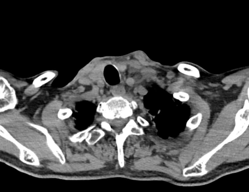 Carotid artery pseudoaneurysm (Radiopaedia 84030-99259 Axial non-contrast 52).jpg