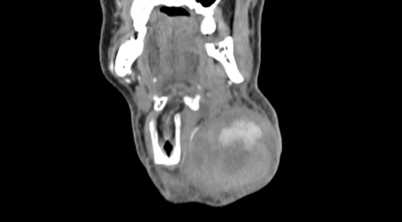 File:Carotid artery pseudoaneurysm (Radiopaedia 84030-99259 D 17).jpg