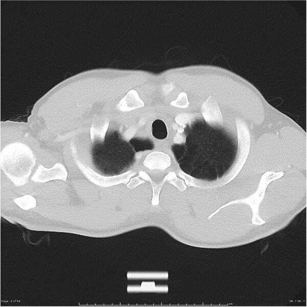 File:Cavitating lung cancer (Radiopaedia 25796-25945 Axial lung window 3).jpg