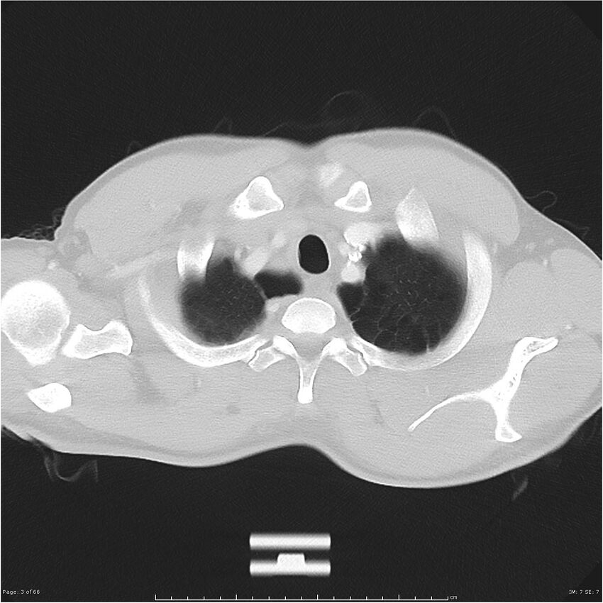 Cavitating lung cancer (Radiopaedia 25796-25945 Axial lung window 3).jpg