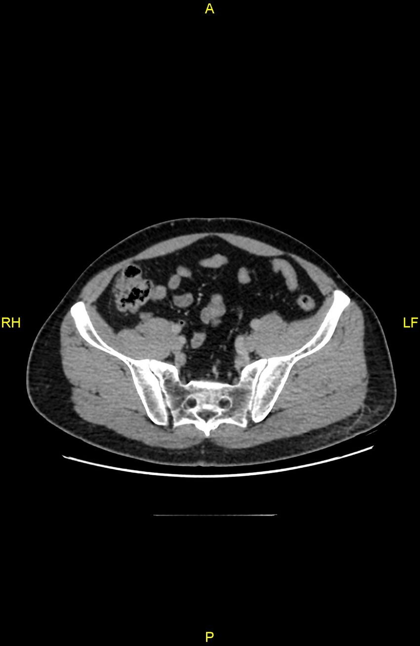 Cecal epiploic appendagitis (Radiopaedia 86047-102164 A 118).jpg