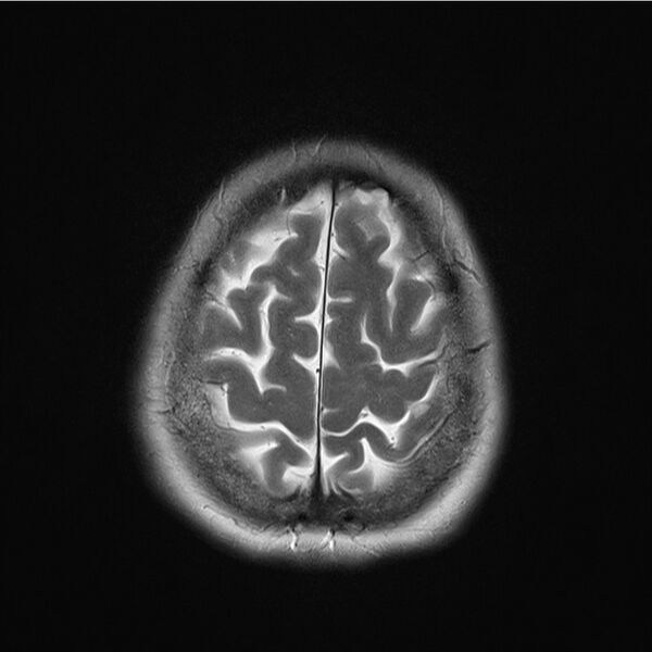 File:Central base of skull meningioma (Radiopaedia 53531-59549 Axial T2 18).jpg
