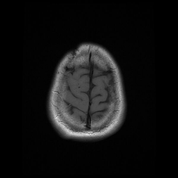 File:Central neurocytoma (Radiopaedia 67618-77021 Axial T1 23).jpg