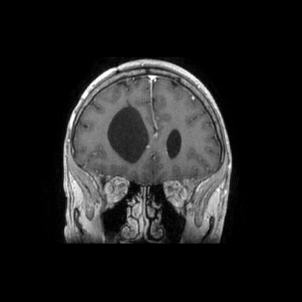 File:Central neurocytoma (Radiopaedia 67618-77021 Coronal T1 C+ 24).jpg