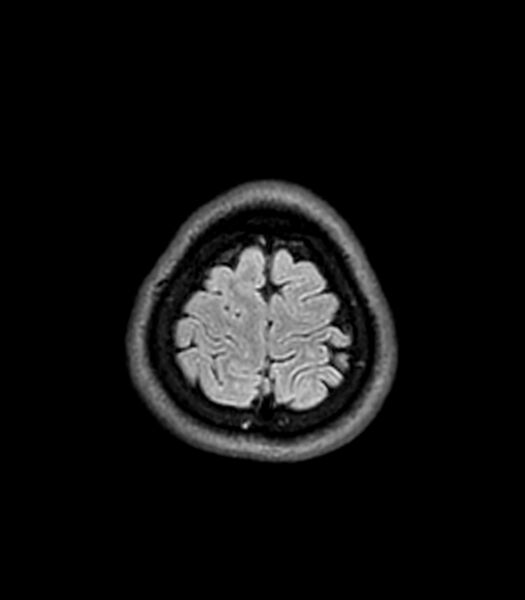File:Central neurocytoma (Radiopaedia 79320-92380 Axial FLAIR 49).jpg