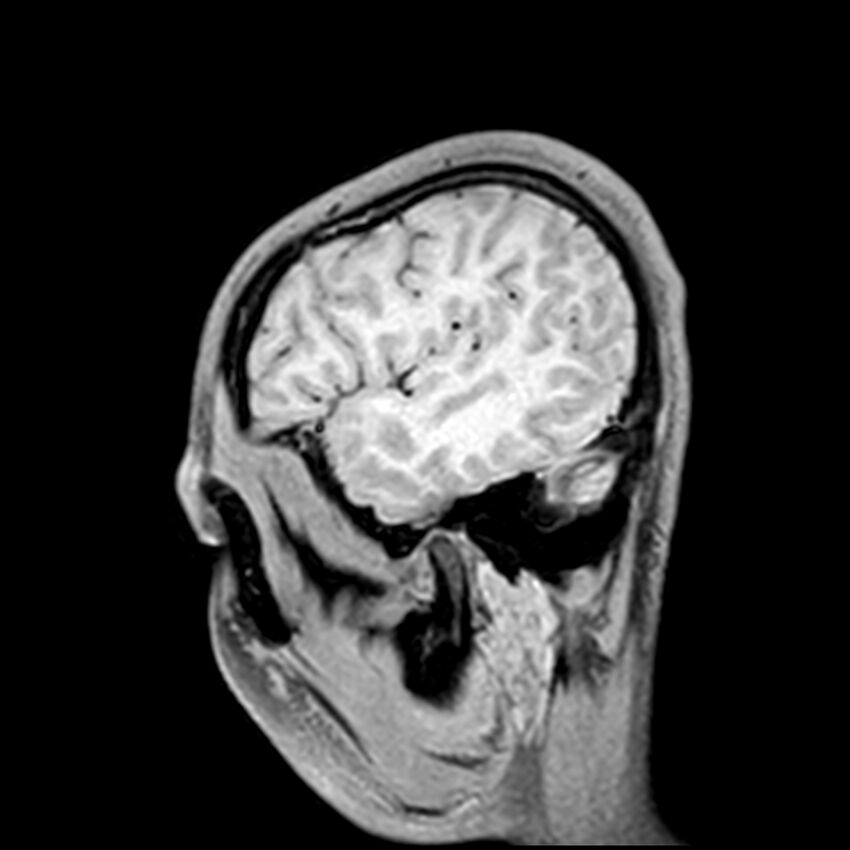 Central neurocytoma (Radiopaedia 79320-92380 Sagittal T1 50).jpg