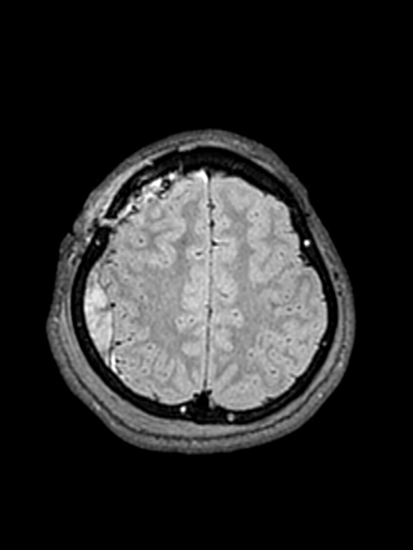 Central neurocytoma (Radiopaedia 79320-92381 Axial FLAIR 47).jpg
