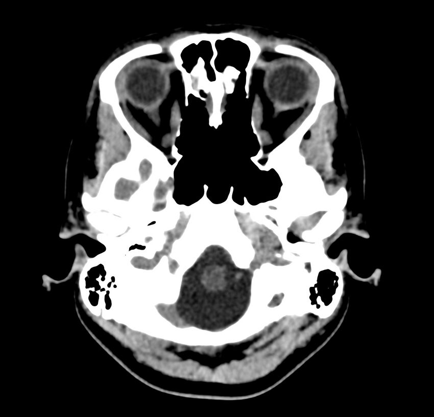 Cerebellar agenesis (Radiopaedia 30203-30817 Axial non-contrast 5).jpg