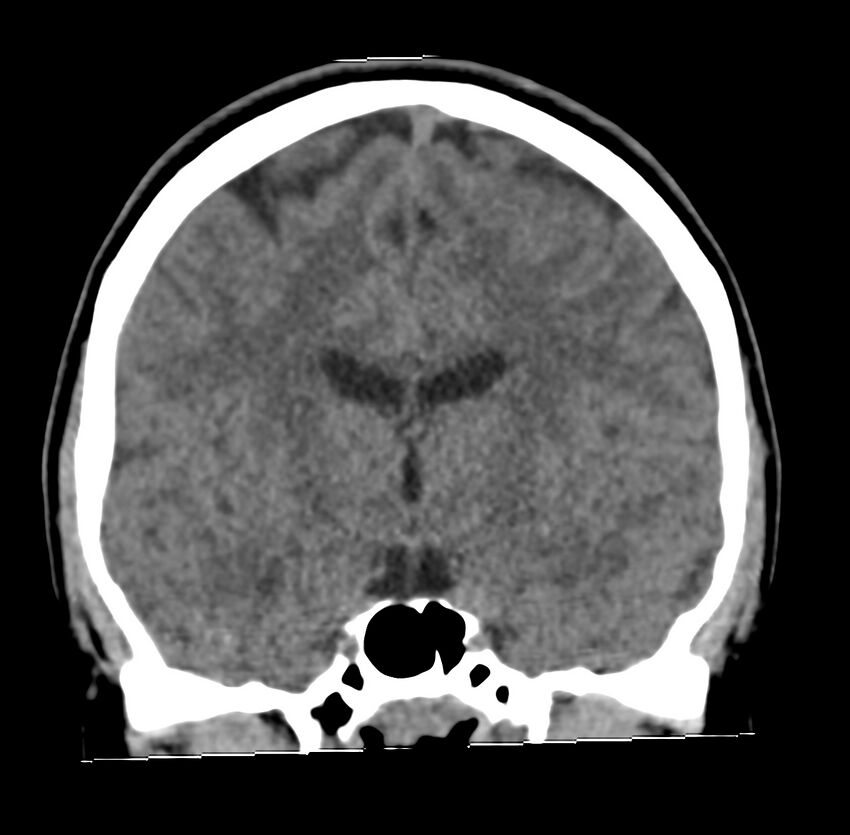 Cerebellar agenesis (Radiopaedia 30203-30817 Coronal non-contrast 19).jpg