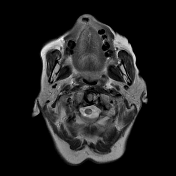 File:Cerebellar ataxia with neuropathy and vestibular areflexia syndrome (CANVAS) (Radiopaedia 74283-85159 Axial T2 1).jpg