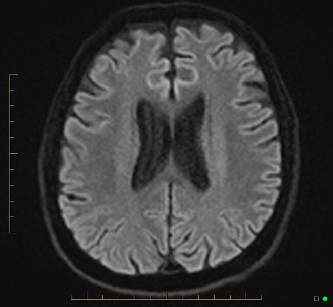 File:Cerebellar gangliocytoma (Radiopaedia 65377-74422 Axial DWI 25).jpg